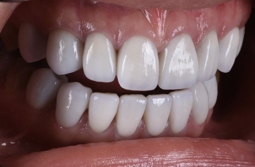 四環黴素染色牙用陶瓷貼片遮色後的側面牙齒